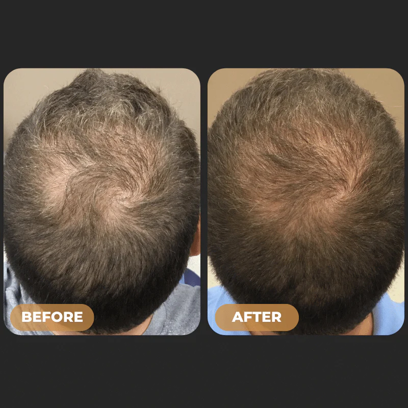 159-spartantm-full-hair-growth-system-4.webp SPARTAN™ - Full Hair Growth System