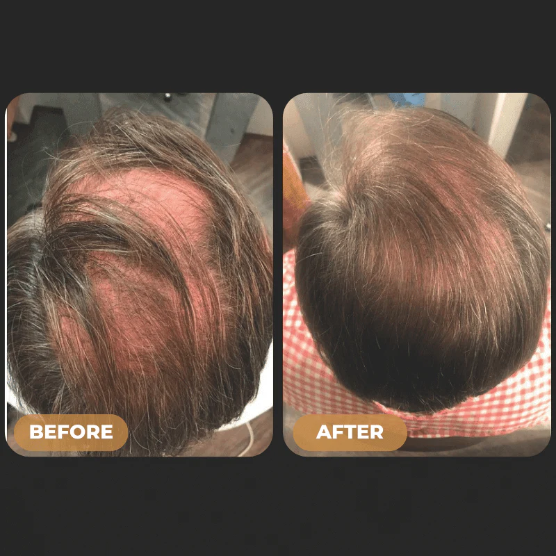 268-spartantm-full-hair-growth-system-5.webp SPARTAN™ - Full Hair Growth System