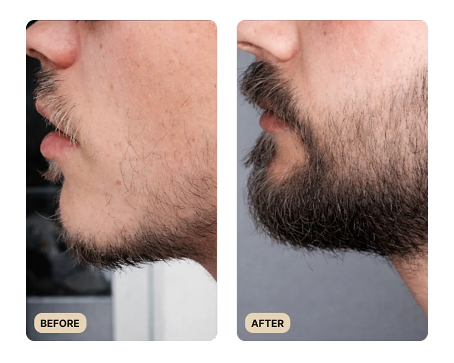 Full Beard Growth System (TEST)